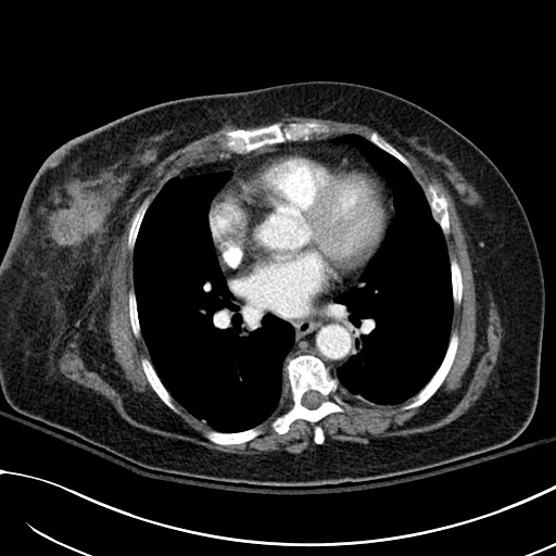 File:Breast carcinoma with pathological hip fracture (Radiopaedia 60314-67974 A 31).jpg