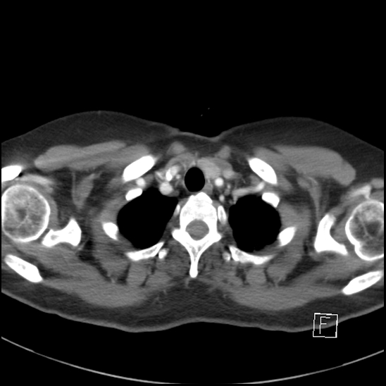 File:Breast metastases from renal cell cancer (Radiopaedia 79220-92225 A 10).jpg