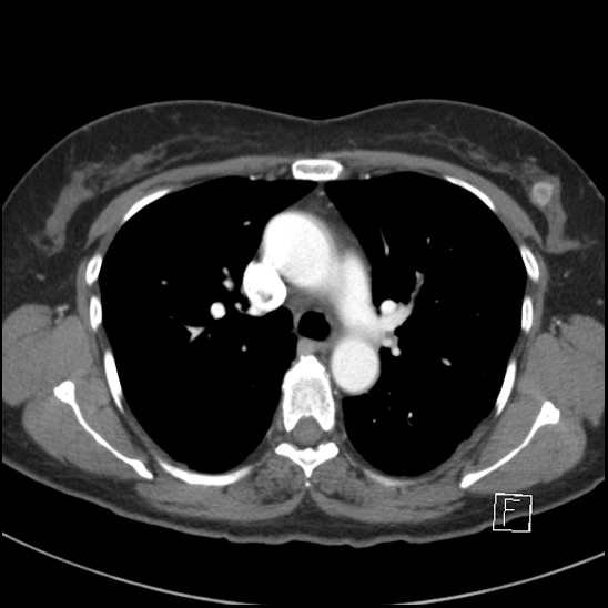Breast metastases from renal cell cancer (Radiopaedia 79220-92225 A 37).jpg