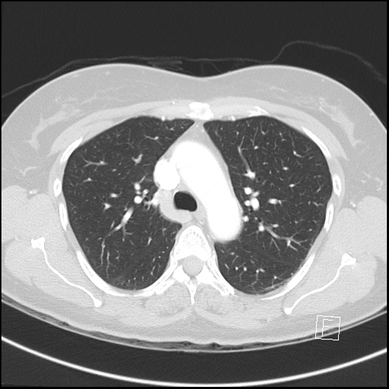 Breast metastases from renal cell cancer (Radiopaedia 79220-92225 Axial lung window 28).jpg