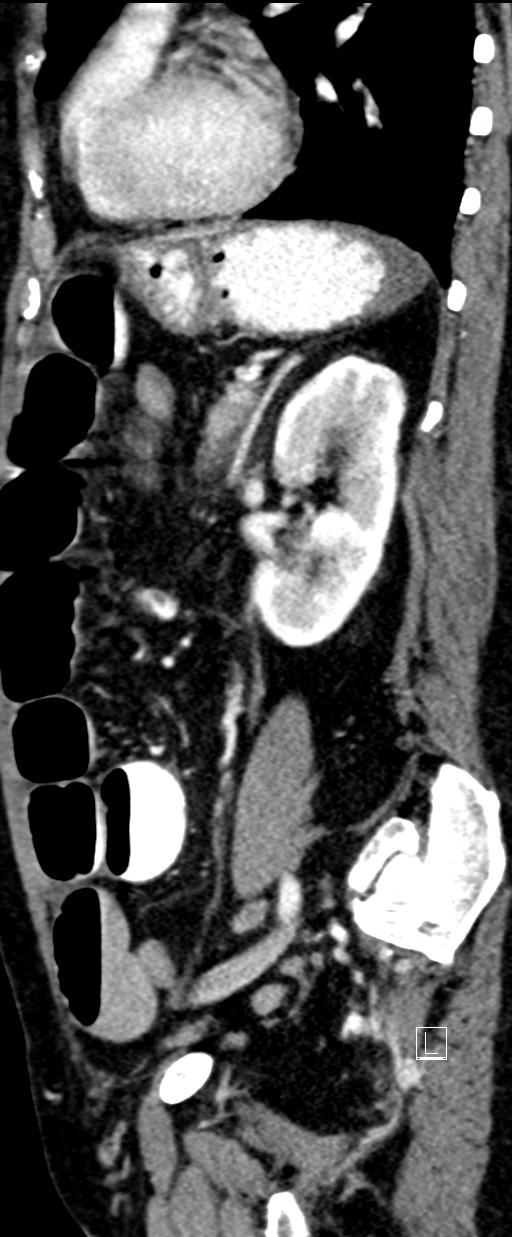 Broad ligament hernia (Radiopaedia 84802-100276 C 23).jpg