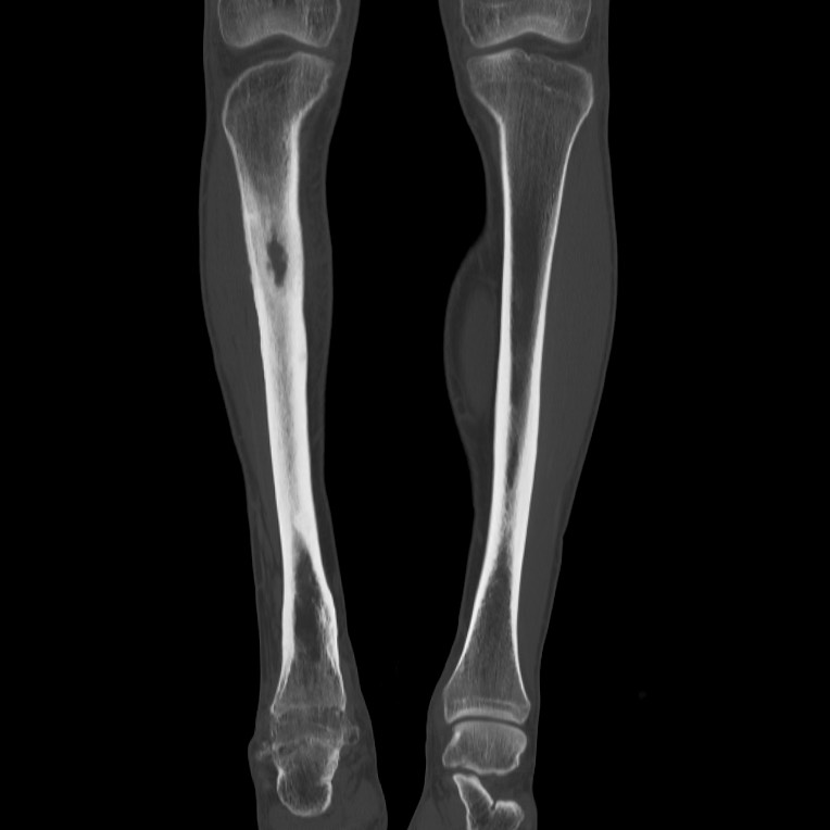 Brodie abscess - tibia (Radiopaedia 66028-75204 Coronal bone window 15).jpg