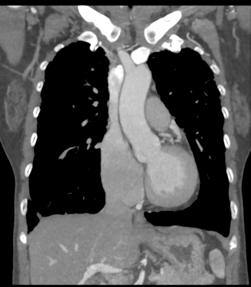 File:Bronchial artery aneurysms (Radiopaedia 42282-45385 Coronal C+ delayed 27).png