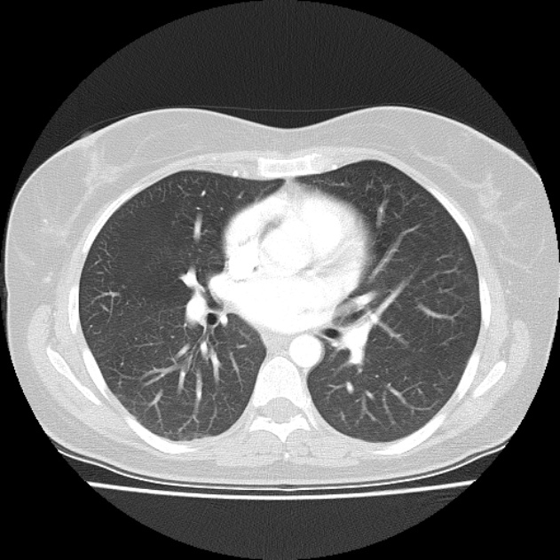 Bronchial atresia (Radiopaedia 22965-22992 Axial lung window 26).jpg