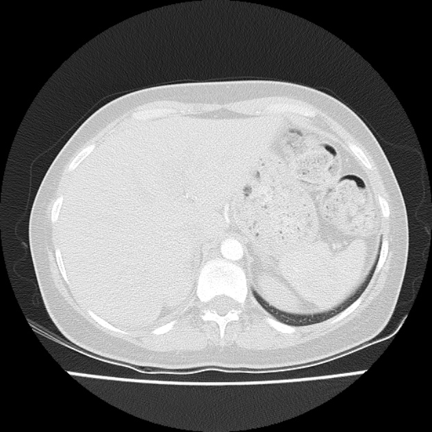 Bronchial atresia (Radiopaedia 22965-22992 Axial lung window 6).jpg