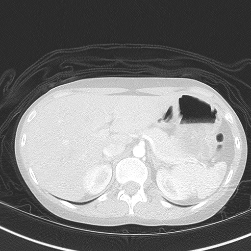 Bronchial atresia (Radiopaedia 73677-84470 Axial lung window 57).jpg