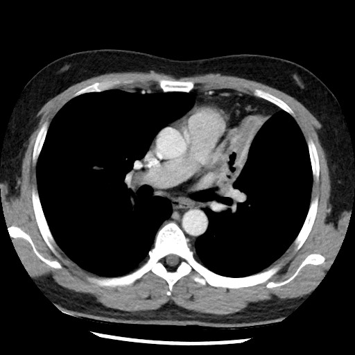Bronchial carcinoid tumor (Radiopaedia 67377-76764 A 30).jpg