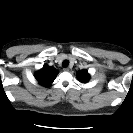 Bronchial carcinoid tumor (Radiopaedia 67377-76764 A 9).jpg