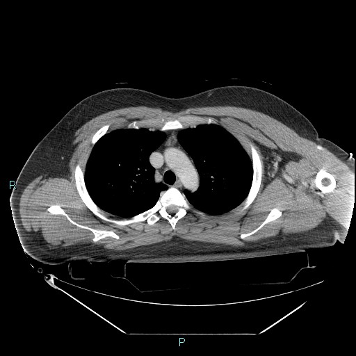 Bronchial carcinoid tumor (Radiopaedia 78272-90870 C 38).jpg