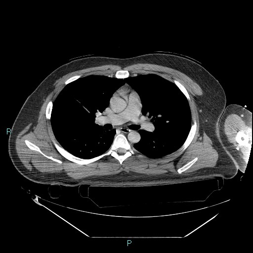 Bronchial carcinoid tumor (Radiopaedia 78272-90870 C 55).jpg