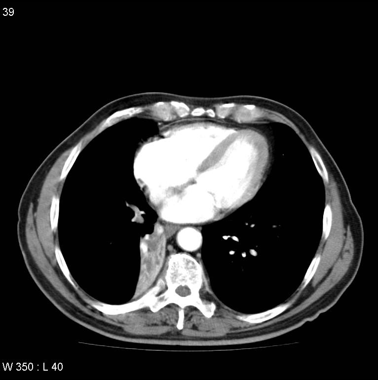 Bronchial carcinoid tumor with right lower lobe collapse (Radiopaedia 29060-29422 A 38).jpg