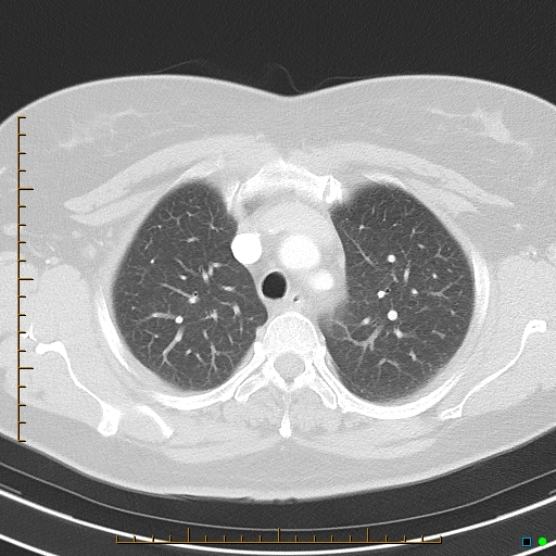 Bronchial diverticula (Radiopaedia 79512-92675 Axial lung window 13).jpg