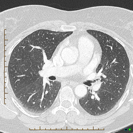File:Bronchial diverticula (Radiopaedia 79512-92676 Axial lung window 90).jpg