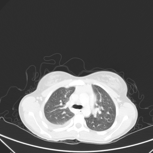 Bronchial mucoepidermoid carcinoma (Radiopaedia 57023-63895 Axial lung window 35).jpg