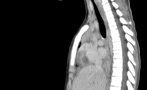 Bronchial mucoepidermoid carcinoma (Radiopaedia 57023-63895 Sagittal 110).jpg