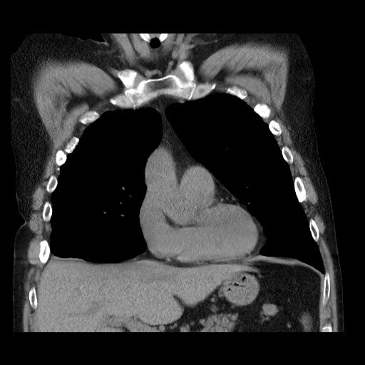 Bronchial stenosis - lung transplant (Radiopaedia 73133-83848 Coronal non-contrast 26).jpg