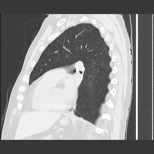 Bronchial stenosis - lung transplant (Radiopaedia 73133-83848 Sagittal lung window 43).jpg