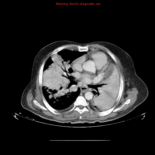 File:Bronchioloalveolar carcinoma (Radiopaedia 9272-9955 A 16).jpg