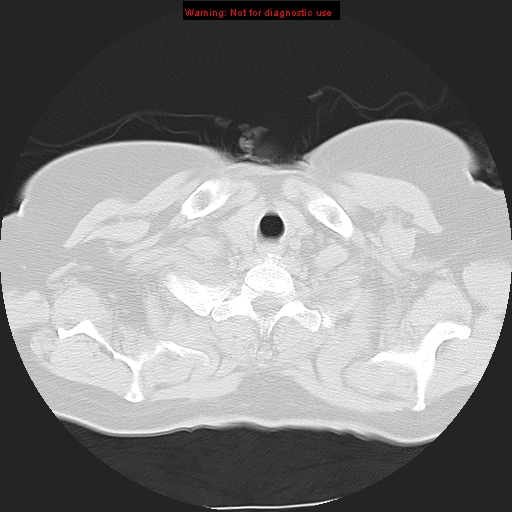 Bronchoalveolar carcinoma (Radiopaedia 13224-13233 Axial lung window 4).jpg