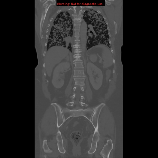 File:Bronchoalveolar carcinoma (Radiopaedia 13224-13233 Coronal non-contrast 16).jpg