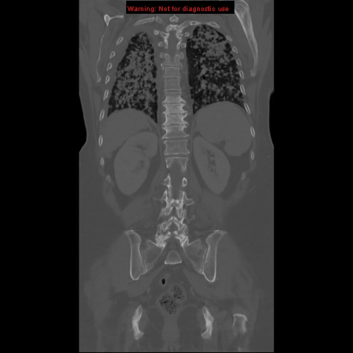 File:Bronchoalveolar carcinoma (Radiopaedia 13224-13233 Coronal non-contrast 20).jpg