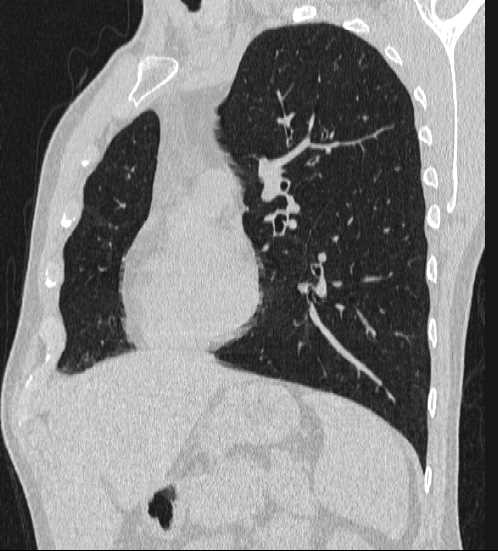File:Bronchocele (Radiopaedia 60676-68429 Oblique lung window 6).jpg