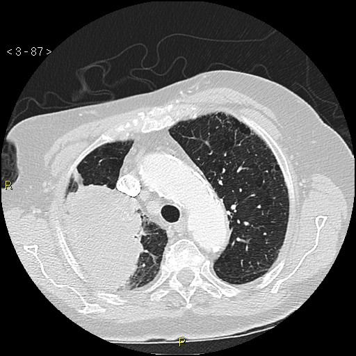 Bronchogenic carcinoma as an incidental finding (Radiopaedia 16453-16130 Axial lung window 87).jpg