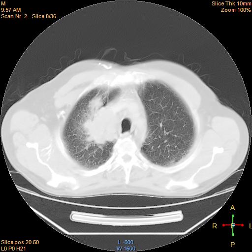 File:Bronchogenic carcinoma with superior vena caval invasion (Radiopaedia 22378-22406 lung window 5).jpg