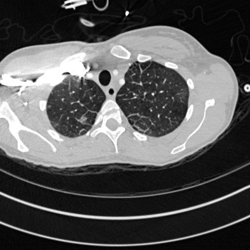 File:Bronchogenic cyst (Radiopaedia 77801-90071 Axial lung window 2).jpg