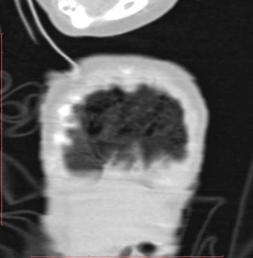 Bronchogenic cyst (Radiopaedia 78599-91409 Coronal lung window 18).jpg