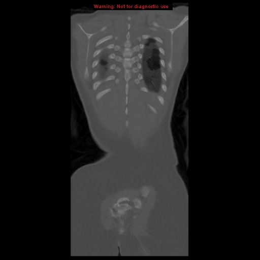 File:Brown tumor (Radiopaedia 12318-12596 D 58).jpg