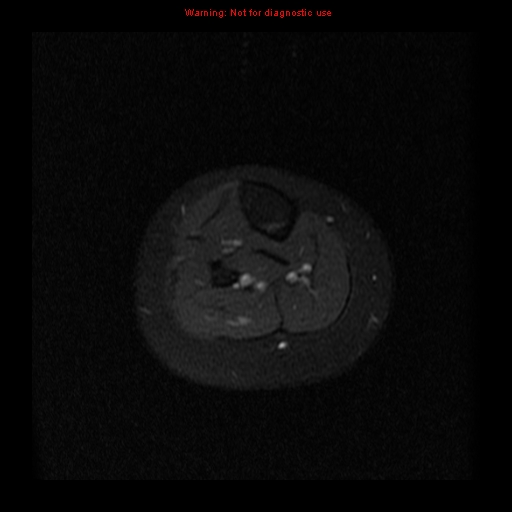 File:Brown tumor (Radiopaedia 12318-12597 Axial T1 C+ fat sat 34).jpg