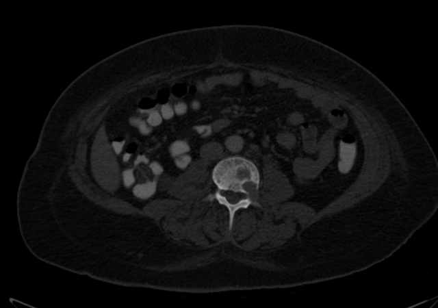 Brown tumors compressing the spinal cord (Radiopaedia 68442-77988 G 68).jpg