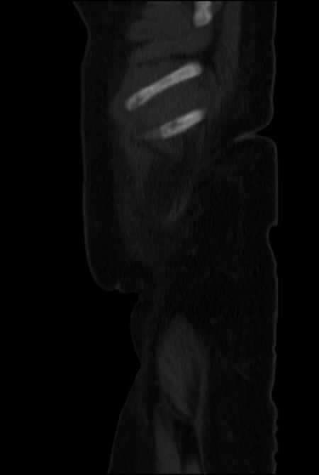 Brown tumors compressing the spinal cord (Radiopaedia 68442-77988 H 4).jpg