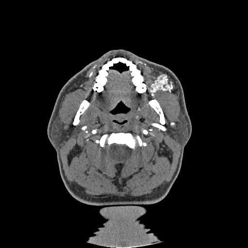 Buccal fat pad arteriovenous malformation (Radiopaedia 70936-81144 D 196).jpg