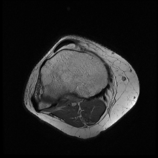 File:Bucket handle meniscus tear (Radiopaedia 56916-63751 Axial PD 17).jpg