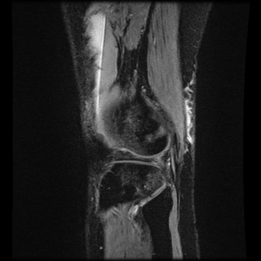 Bucket handle meniscus tear (Radiopaedia 56916-63751 H 9).jpg