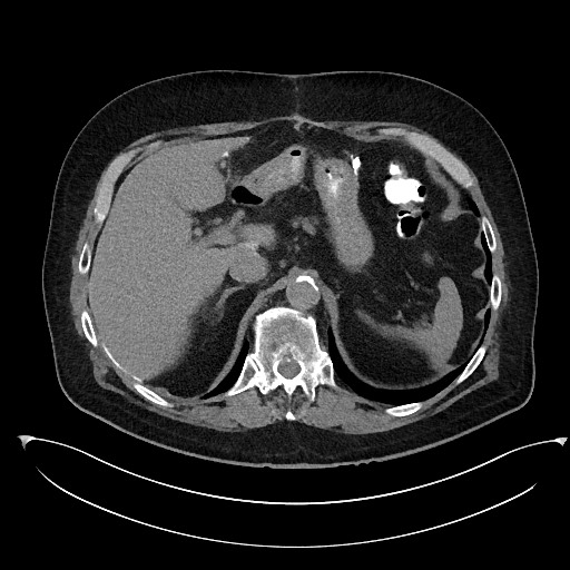 File:Buried bumper syndrome - gastrostomy tube (Radiopaedia 63843-72577 Axial Inject 24).jpg