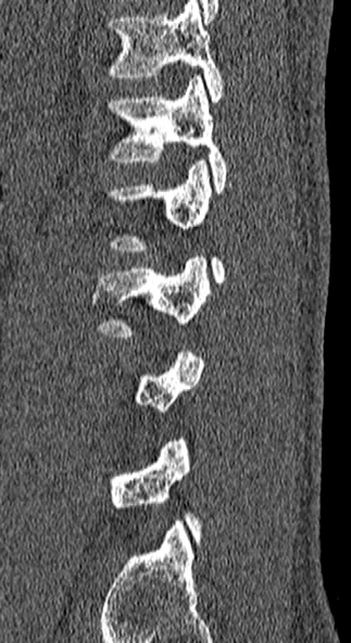 File:Burst fracture (Radiopaedia 53373-59357 Sagittal bone window 14).jpg