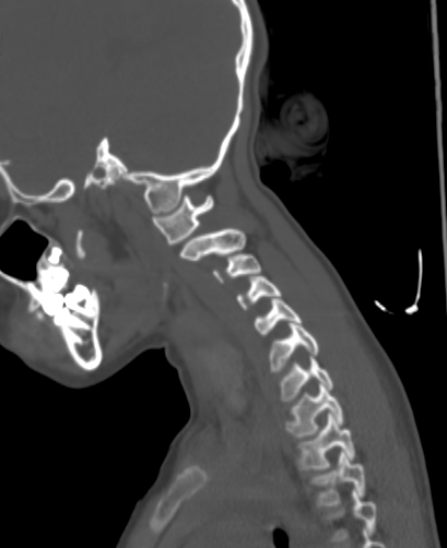 File:Butterfly vertebra (Radiopaedia 77903-90209 Sagittal bone window 77).jpg
