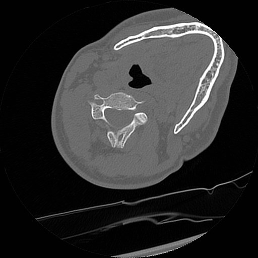 C1-C2 "subluxation" - normal cervical anatomy at maximum head rotation (Radiopaedia 42483-45607 Axial non-contrast 24).jpg