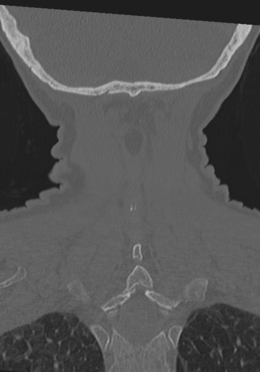 C2 fracture with vertebral artery dissection (Radiopaedia 37378-39199 Coronal bone window 49).png