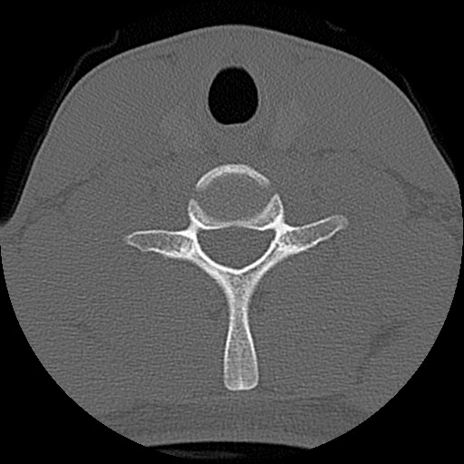 File:C5 facet fracture (Radiopaedia 58374-65499 Axial bone window 68).jpg
