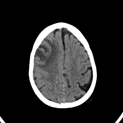 File:CNS Lymphoma (Radiopaedia 44198-47794 Axial non-contrast 28).png