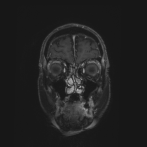File:CNS lymphoma with steroid response (Radiopaedia 37980-39921 Coronal T1 C+ 2).png
