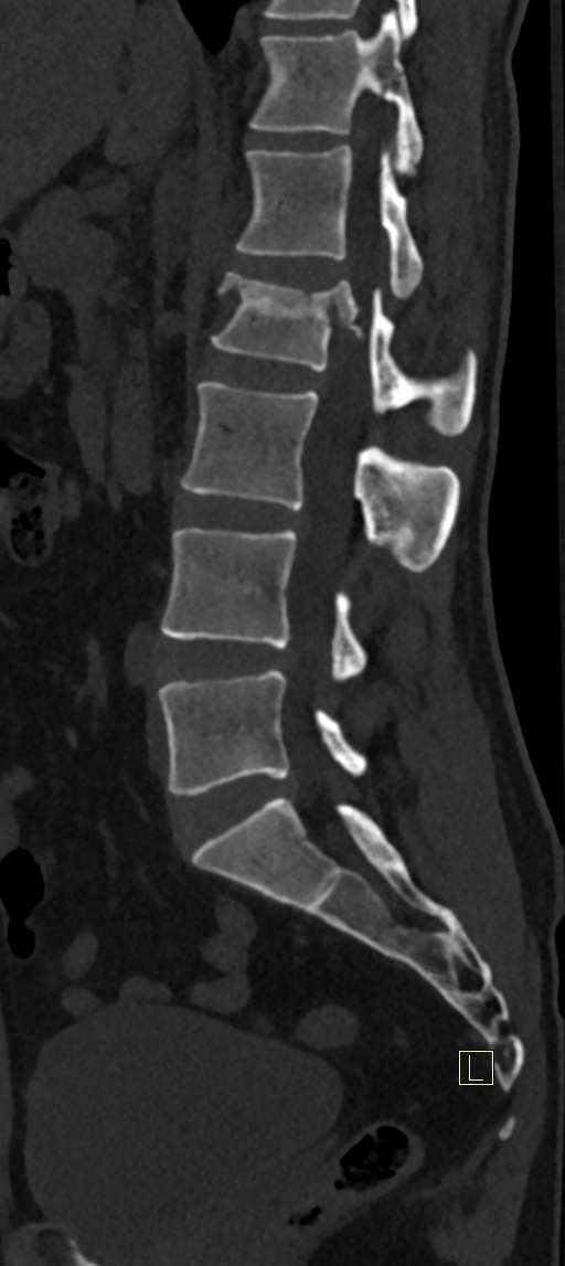 Calcaneal fractures with associated L2 burst fracture (Radiopaedia 71671-82493 Sagittal bone window 39).jpg