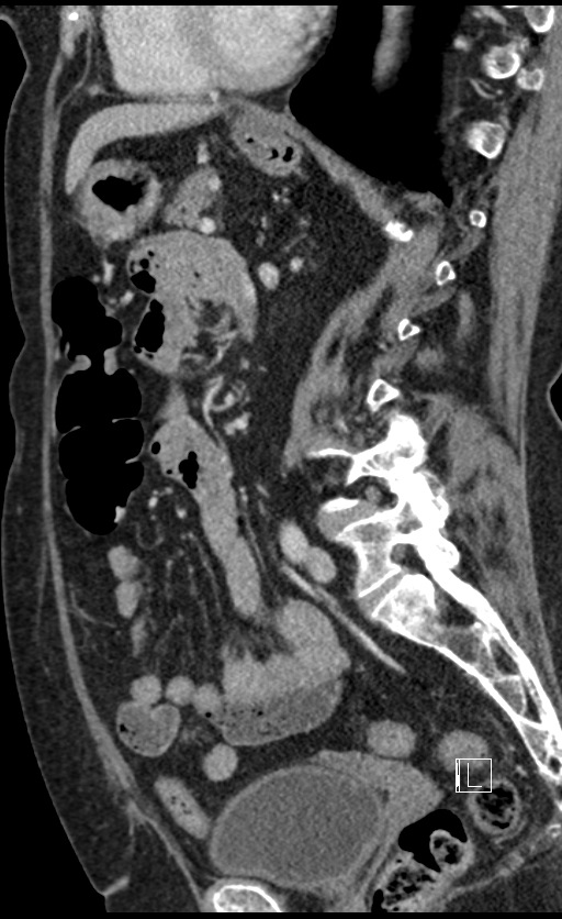 Calcified adrenal glands and Spigelian hernia (Radiopaedia 49741-54988 C 70).jpg