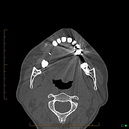 Calcified facial augmentation fillers (Radiopaedia 79514-92679 Axial bone window 105).jpg