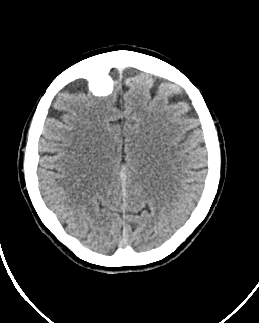 Calcified meningioma (Radiopaedia 74361-85243 Axial non-contrast 18).jpg