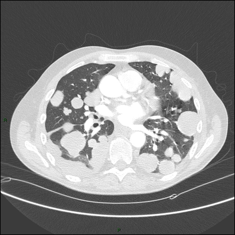 Cannonball metastases (Radiopaedia 82110-96150 Axial lung window 107).jpg